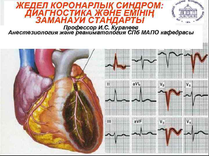 ЖЕДЕЛ КОРОНАРЛЫҚ СИНДРОМ: ДИАГНОСТИКА ЖӘНЕ ЕМІНІҢ ЗАМАНАУИ СТАНДАРТЫ Профессор И. С. Курапеев Анестезиология және