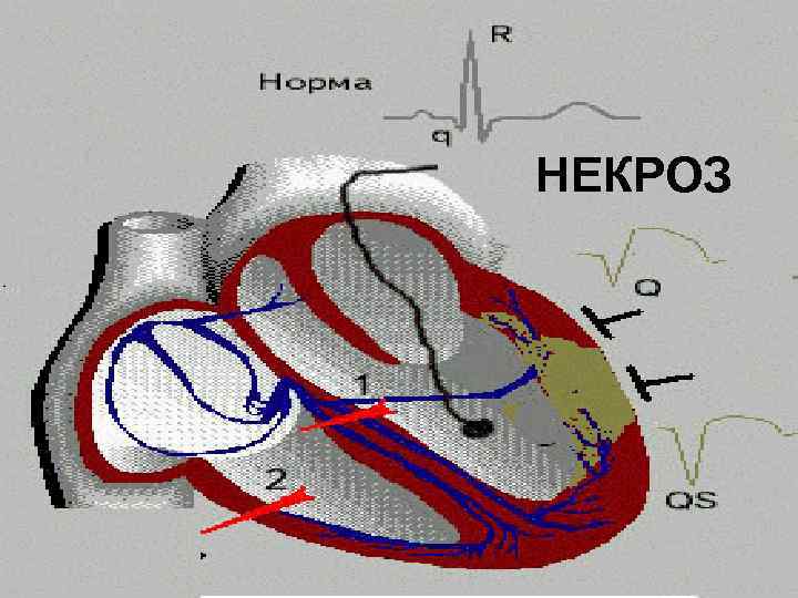 НЕКРОЗ 
