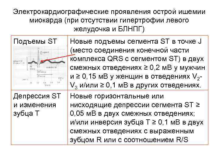 Электрокардиографические проявления острой ишемии миокарда (при отсутствии гипертрофии левого желудочка и БЛНПГ) Подъемы ST