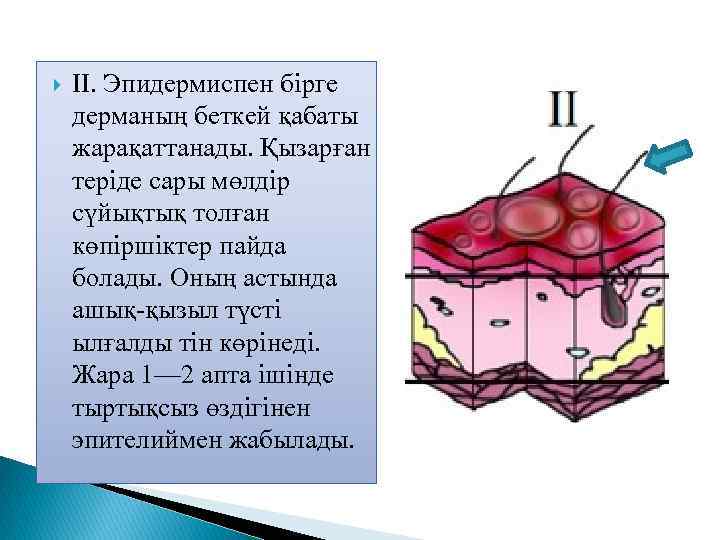  II. Эпидермиспен бірге дерманың беткей қабаты жарақаттанады. Қызарған теріде сары мөлдір сүйықтық толған