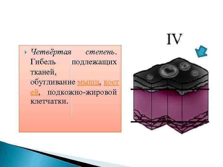  Четвёртая степень. Гибель подлежащих тканей, обугливание мышц, кост ей, подкожно-жировой клетчатки. 