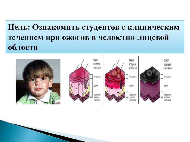 Цель: Ознакомить студентов с клиническим течением при ожогов в челюстно-лицевой облости 