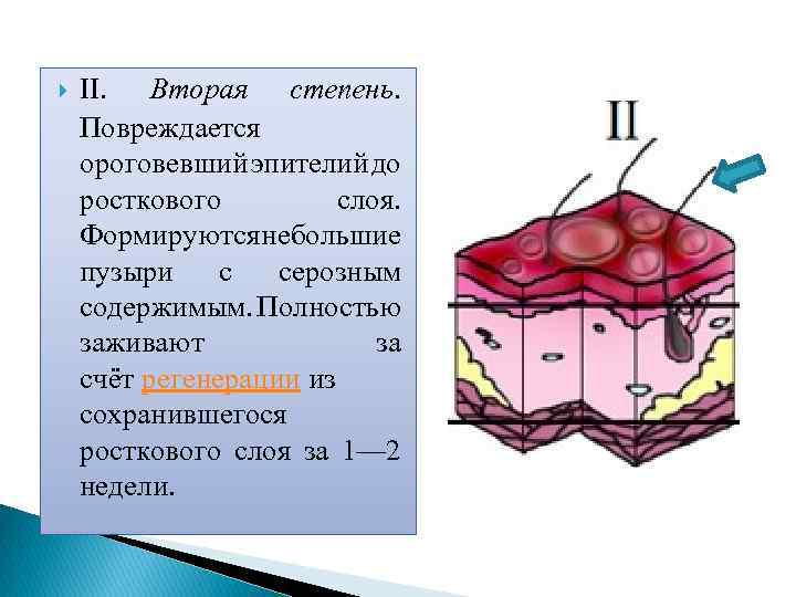  II. Вторая степень. Повреждается ороговевший эпителий до росткового слоя. Формируются ебольшие н пузыри