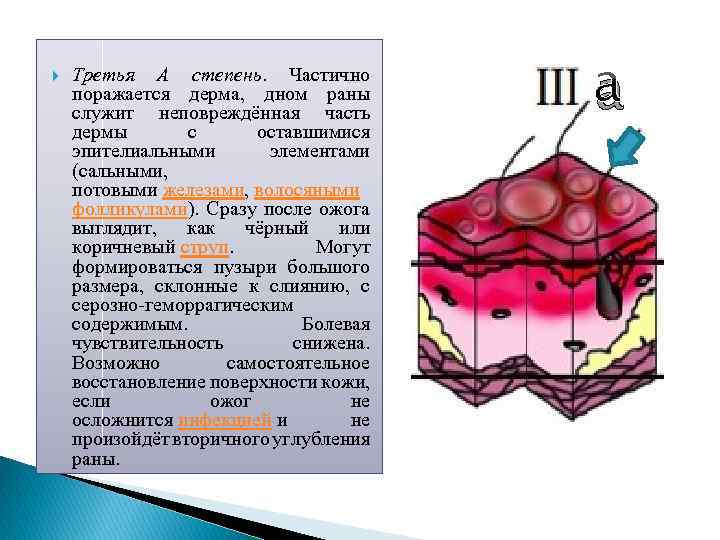  Третья А степень. Частично поражается дерма, дном раны служит неповреждённая часть дермы с