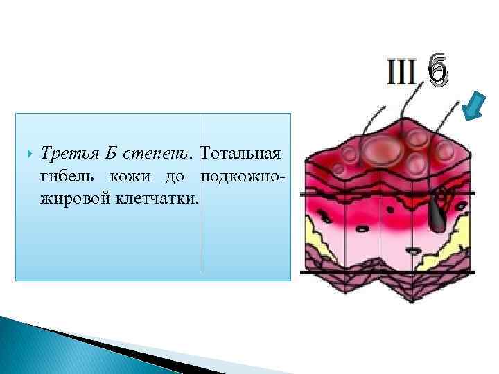 б Третья Б степень. Тотальная гибель кожи до подкожножировой клетчатки. 