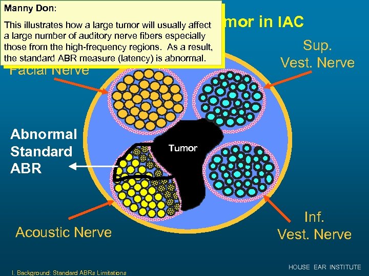 Manny Don: Medium or Large Tumor in IAC This illustrates how a large tumor