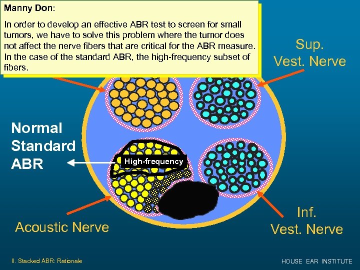 Manny Don: Small Tumor in IAC In order to develop an effective ABR test