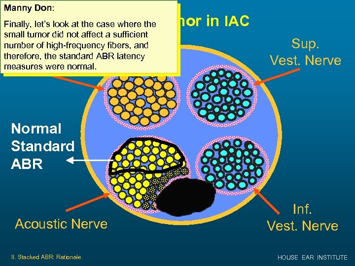 Manny Don: Small Tumor in IAC Finally, let’s look at the case where the