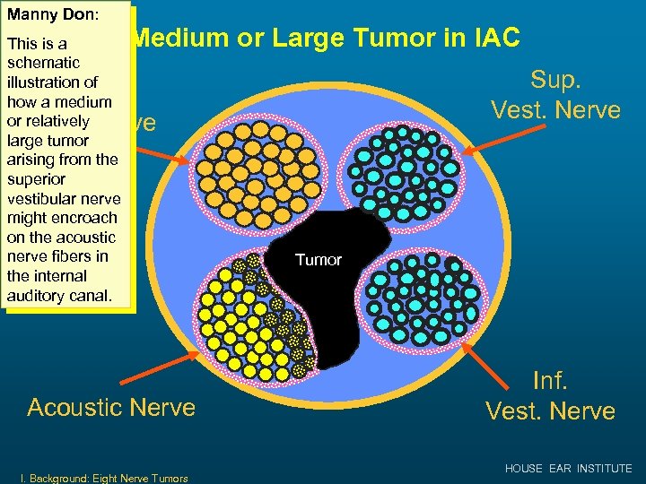 Manny Don: Medium or Large Tumor in IAC This is a schematic illustration of