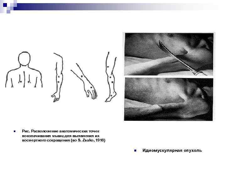 n Рис. Расположение анатомических точек поколачивания мышц для выявления их посмертного сокращения (по S.