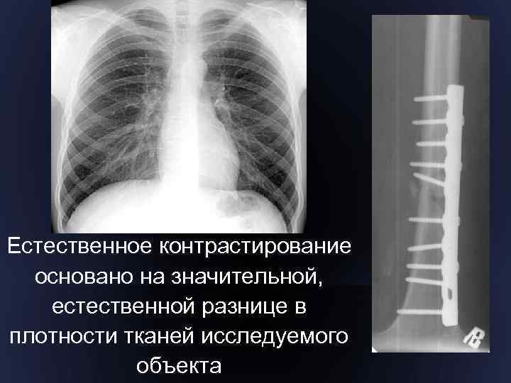 Естественное контрастирование основано на значительной, естественной разнице в плотности тканей исследуемого объекта 