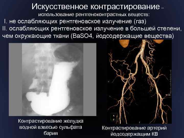 Искусственное контрастирование – использование рентгеноконтрастных веществ: I. не ослабляющих рентгеновское излучение (газ) II. ослабляющих