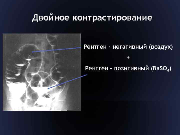 Двойное контрастирование Рентген - негативный (воздух) + Рентген - позитивный (Ba. SO 4) 