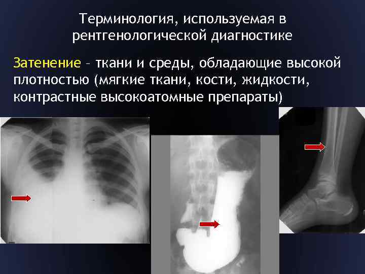 Терминология, используемая в рентгенологической диагностике Затенение – ткани и среды, обладающие высокой плотностью (мягкие