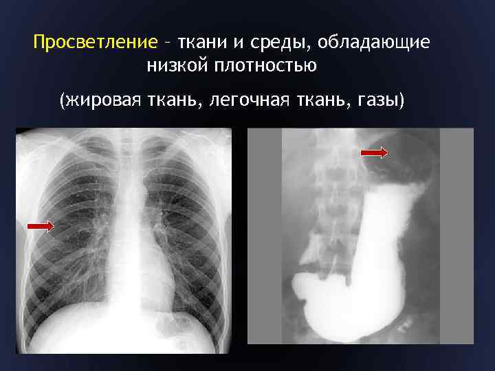 Просветление – ткани и среды, обладающие низкой плотностью (жировая ткань, легочная ткань, газы) 