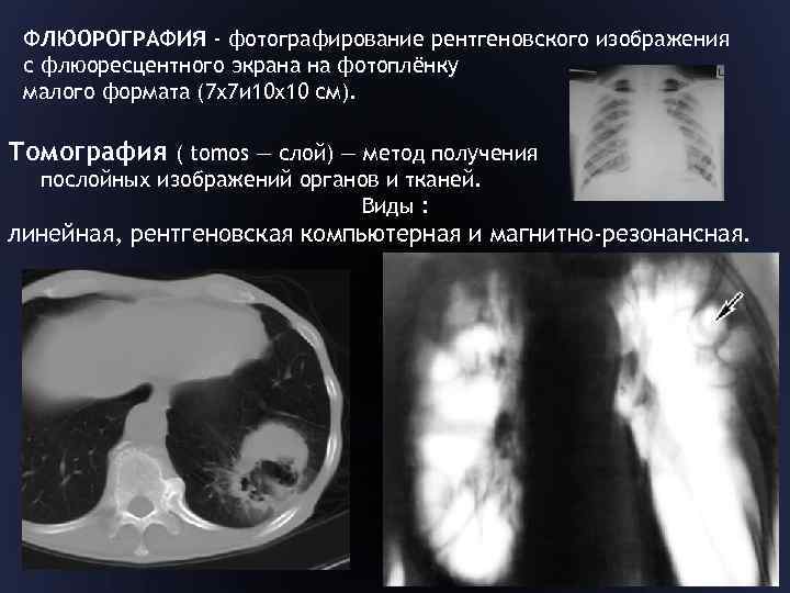 ФЛЮОРОГРАФИЯ - фотографирование рентгеновского изображения с флюоресцентного экрана на фотоплёнку малого формата (7 х7