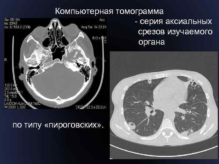 Компьютерная томограмма - серия аксиальных срезов изучаемого органа по типу «пироговских» . 