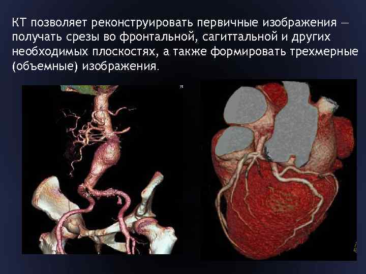 КТ позволяет реконструировать первичные изображения — получать срезы во фронтальной, сагиттальной и других необходимых