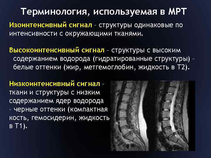 Терминология, используемая в МРТ Изоинтенсивный сигнал – структуры одинаковые по интенсивности с окружающими тканями.