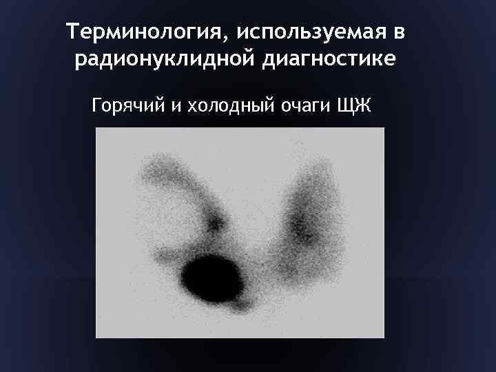 Терминология, используемая в радионуклидной диагностике Горячий и холодный очаги ЩЖ 