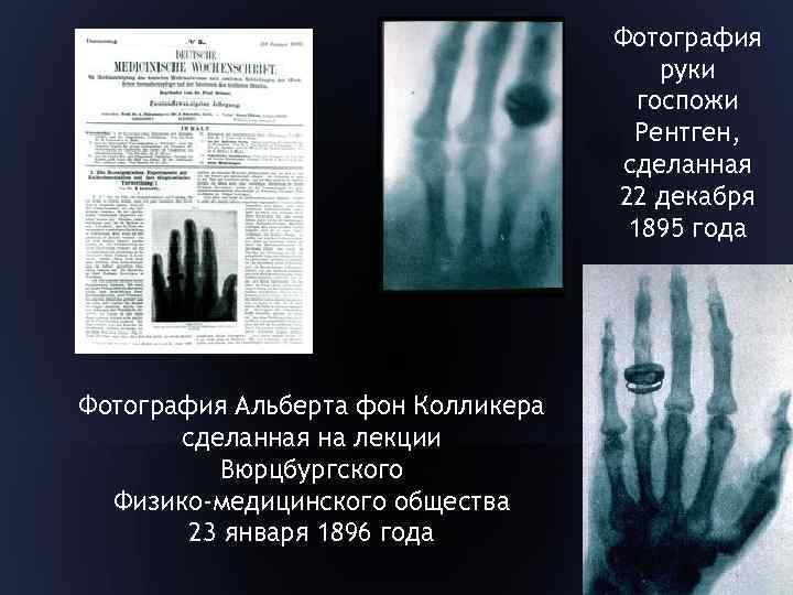Фотография руки госпожи Рентген, сделанная 22 декабря 1895 года Фотография Альберта фон Колликера сделанная