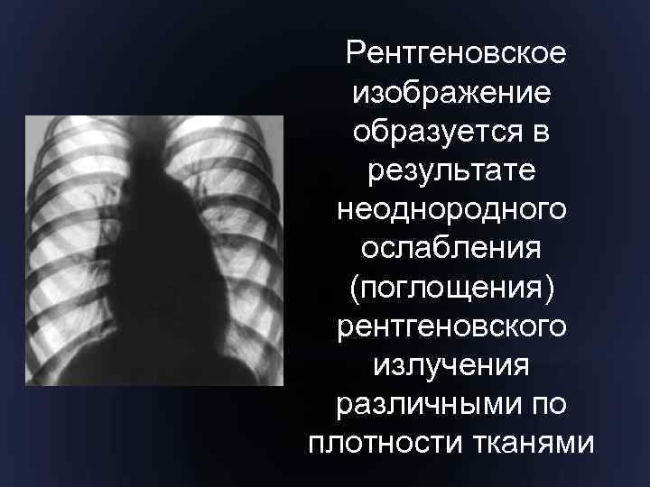 Рентгеновское изображение образуется в результате неоднородного ослабления (поглощения) рентгеновского излучения различными по плотности тканями