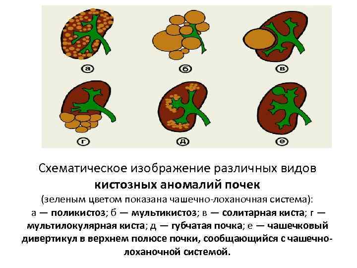 Схематическое изображение различных видов кистозных аномалий почек (зеленым цветом показана чашечно-лоханочная система): а —