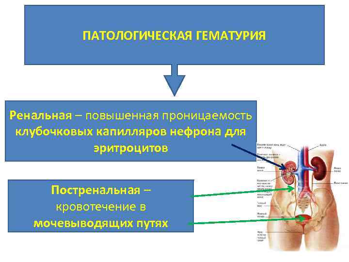 ПАТОЛОГИЧЕСКАЯ ГЕМАТУРИЯ Ренальная – повышенная проницаемость клубочковых капилляров нефрона для эритроцитов Постренальная – кровотечение