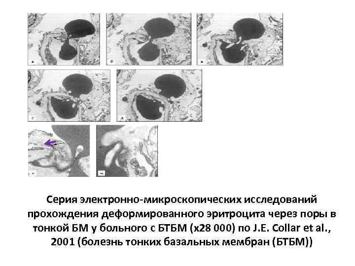 Серия электронно-микроскопических исследований прохождения деформированного эритроцита через поры в тонкой БМ у больного с