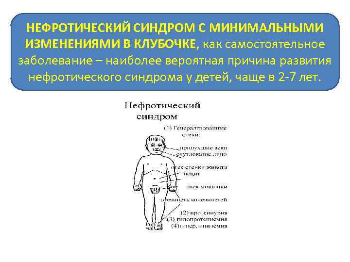 НЕФРОТИЧЕСКИЙ СИНДРОМ С МИНИМАЛЬНЫМИ ИЗМЕНЕНИЯМИ В КЛУБОЧКЕ, как самостоятельное заболевание – наиболее вероятная причина