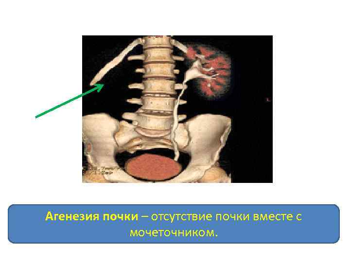 Агенезия почки – отсутствие почки вместе с мочеточником. 