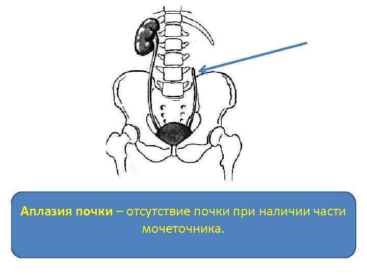 Аплазия почки – отсутствие почки при наличии части мочеточника. 