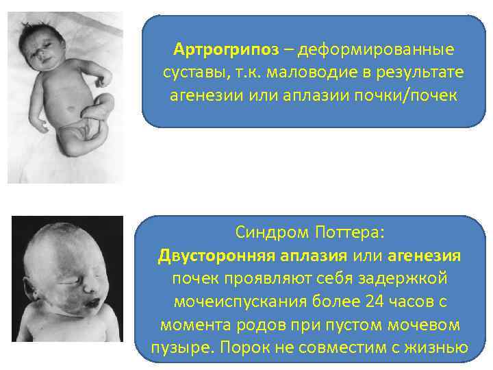 Артрогрипоз – деформированные суставы, т. к. маловодие в результате агенезии или аплазии почки/почек Синдром