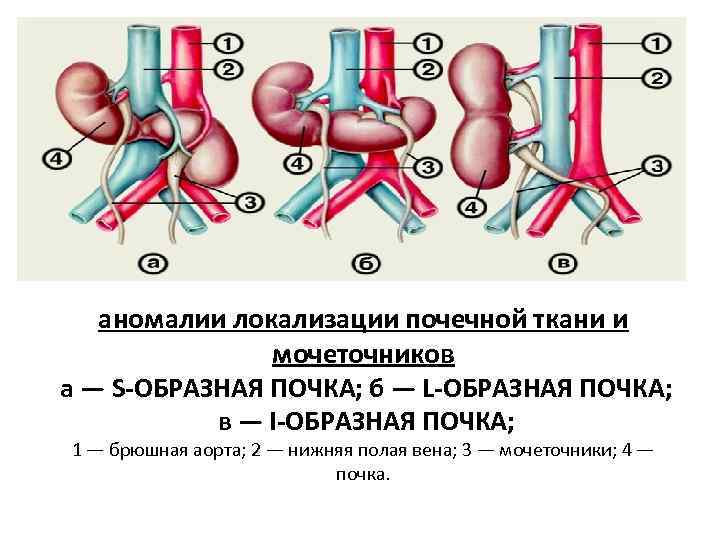 аномалии локализации почечной ткани и мочеточников а — S-ОБРАЗНАЯ ПОЧКА; б — L-ОБРАЗНАЯ ПОЧКА;