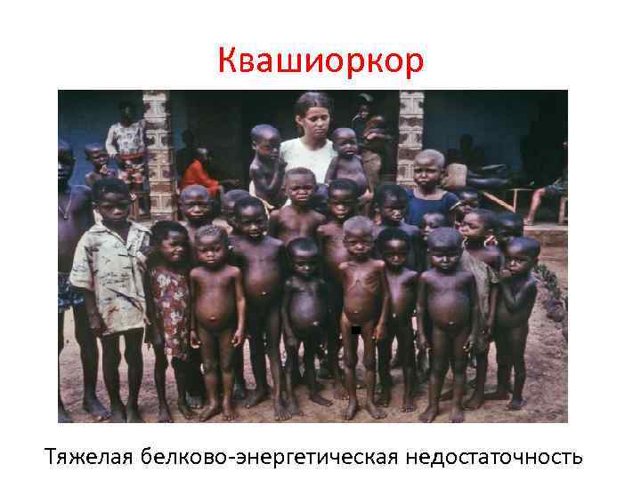 Квашиоркор Тяжелая белково энергетическая недостаточность 