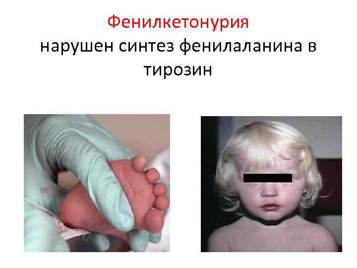 Фенилкетонурия нарушен синтез фенилаланина в тирозин 
