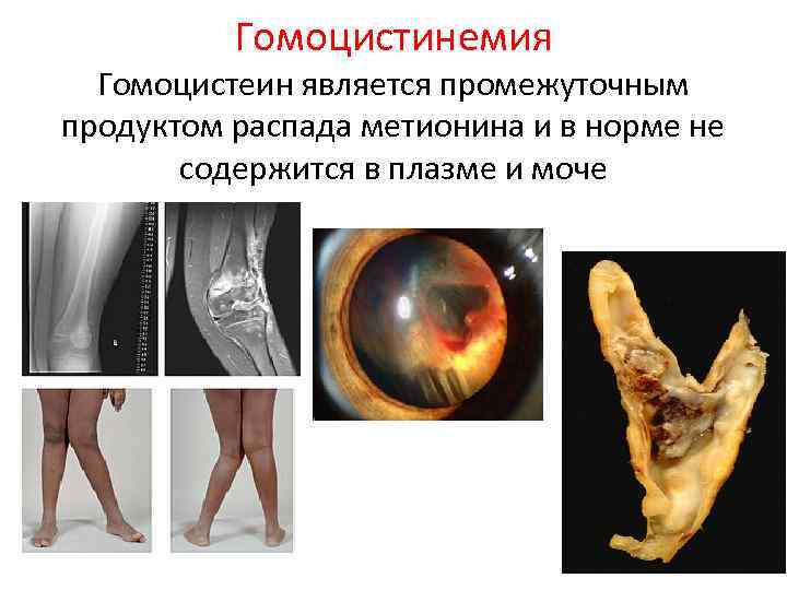 Гомоцистинемия Гомоцистеин является промежуточным продуктом распада метионина и в норме не содержится в плазме