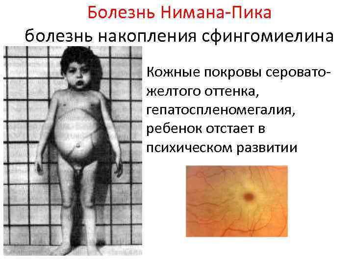 Болезнь Нимана Пика болезнь накопления сфингомиелина Кожные покровы серовато желтого оттенка, гепатоспленомегалия, ребенок отстает