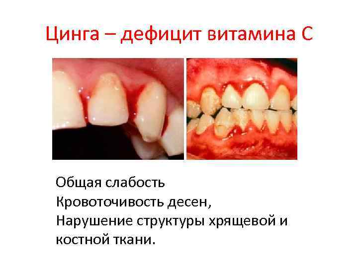 Цинга – дефицит витамина С Общая слабость Кровоточивость десен, Нарушение структуры хрящевой и костной
