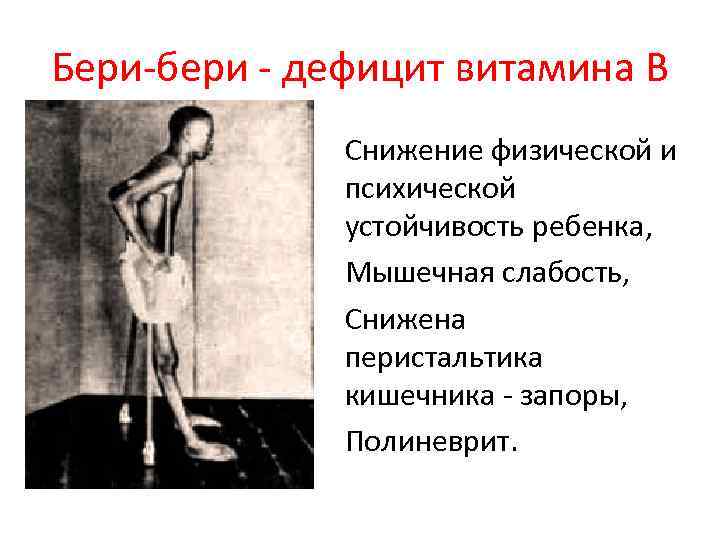 Бери бери дефицит витамина В Снижение физической и психической устойчивость ребенка, Мышечная слабость, Снижена