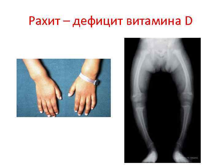 Рахит – дефицит витамина D 
