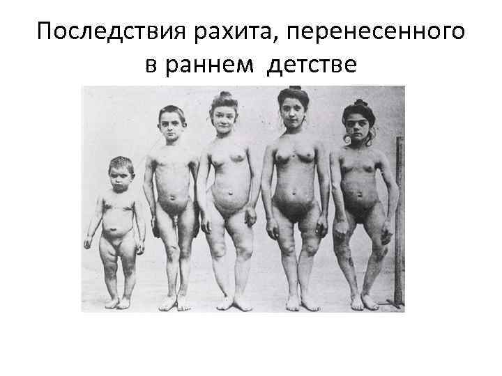 Последствия рахита, перенесенного в раннем детстве 