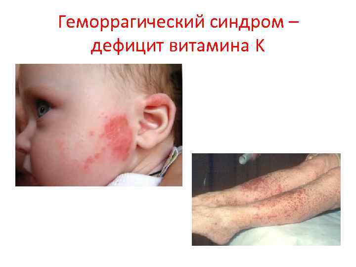 Геморрагический синдром – дефицит витамина K 