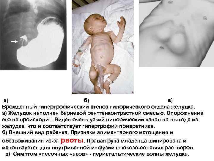 а) б) в) Врожденный гипертрофический стеноз пилорического отдела желудка. а) Желудок наполнен бариевой рентгенконтрастной