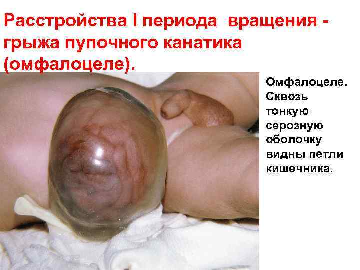 Расстройства I периода вращения грыжа пупочного канатика (омфалоцеле). Омфалоцеле. Сквозь тонкую серозную оболочку видны