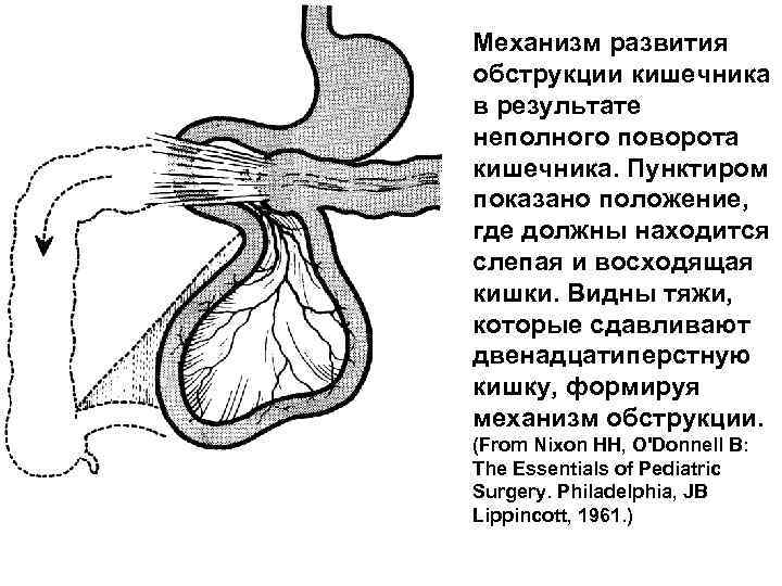 Механизм развития обструкции кишечника в результате неполного поворота кишечника. Пунктиром показано положение, где должны