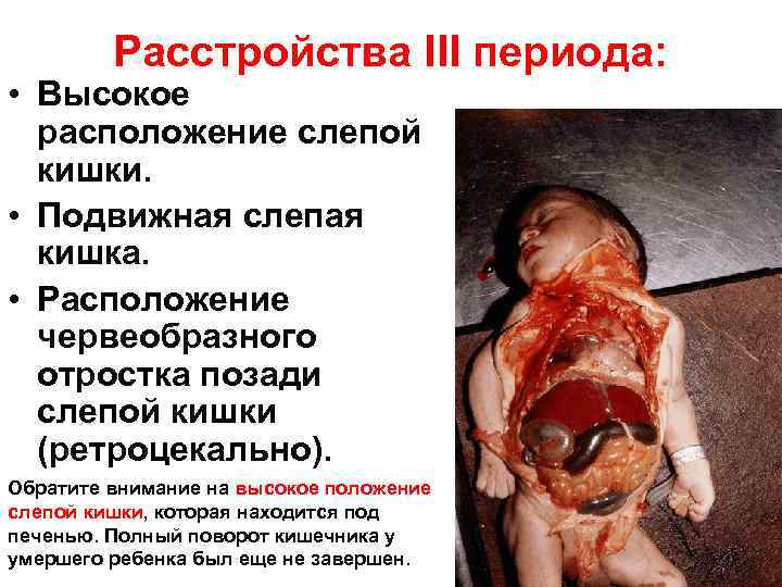 Расстройства III периода: • Высокое расположение слепой кишки. • Подвижная слепая кишка. • Расположение