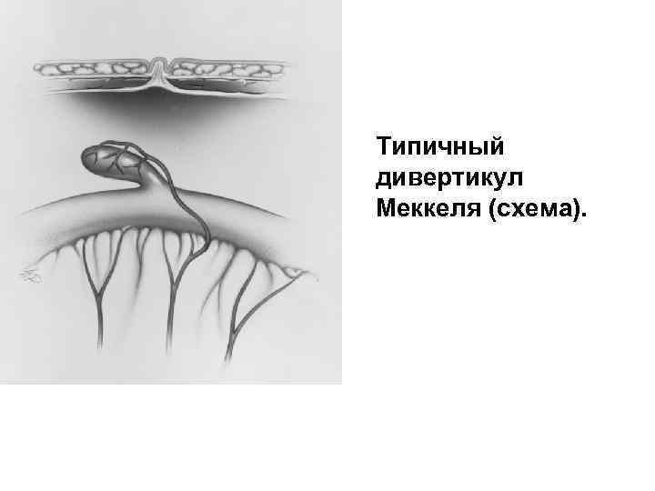 Типичный дивертикул Меккеля (схема). 