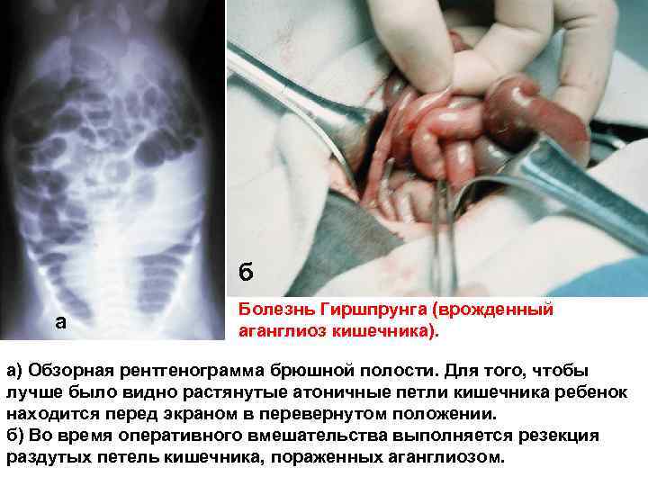 б а Болезнь Гиршпрунга (врожденный аганглиоз кишечника). а) Обзорная рентгенограмма брюшной полости. Для того,