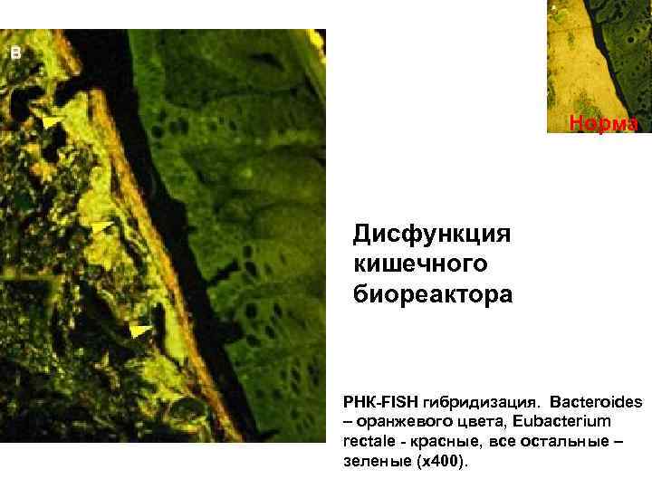 Норма Дисфункция кишечного биореактора РНК-FISH гибридизация. Bacteroides – оранжевого цвета, Eubacterium rectale - красные,